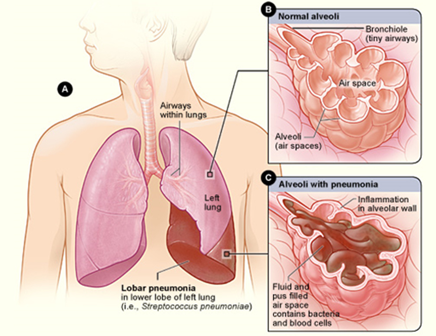 Pneumonia Graphic