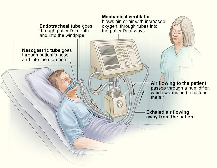 Ventilator Support Graphic