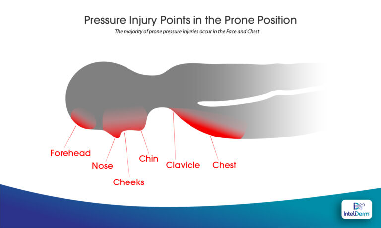 Prone Position And Unique Areas At Risk For Pressure Injury Turn Medical