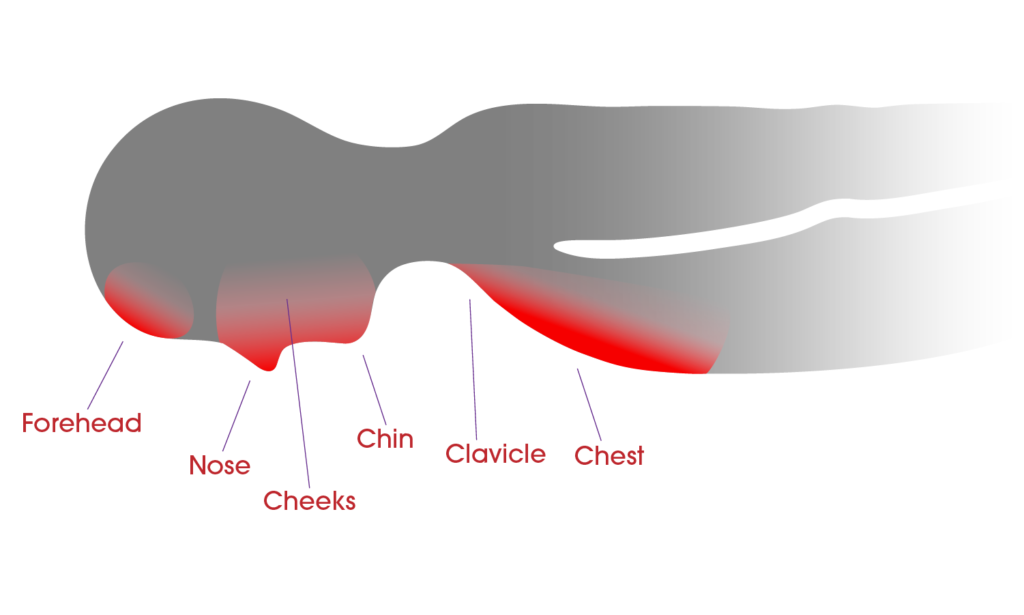 InteliDerm Pressure Points in the Prone Position