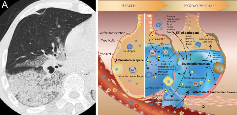 ARDS Etiology A