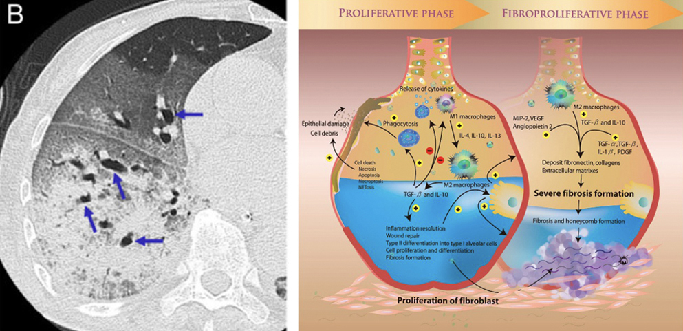 ARDS Etiology B