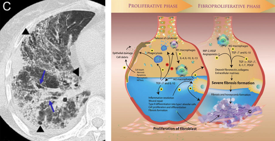 ARDS Etiology C